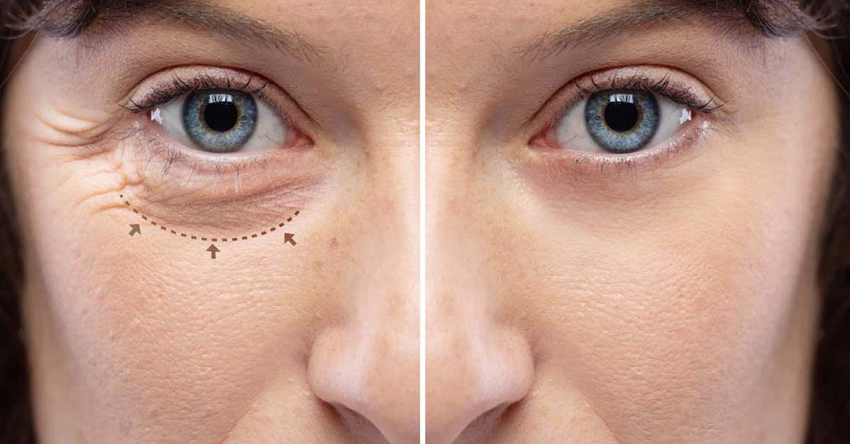 How Long Does Botox Last Around Eyes