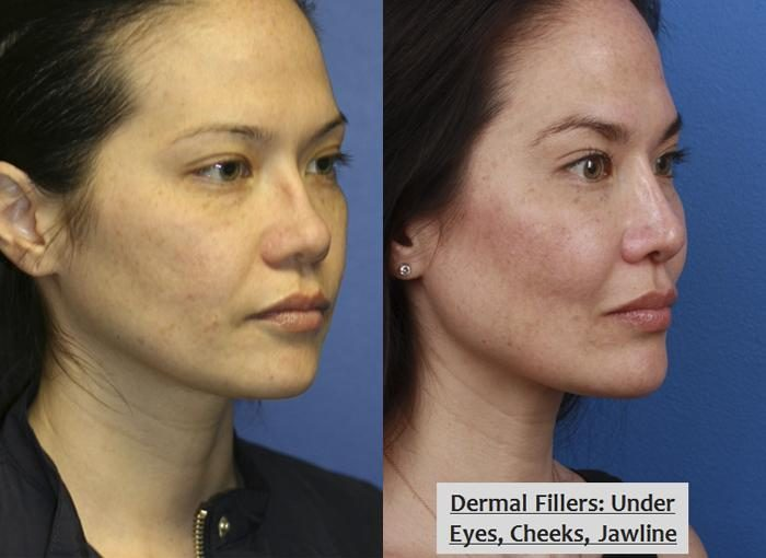 liquid facelift results in new york