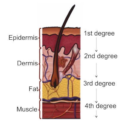 First degree burns 