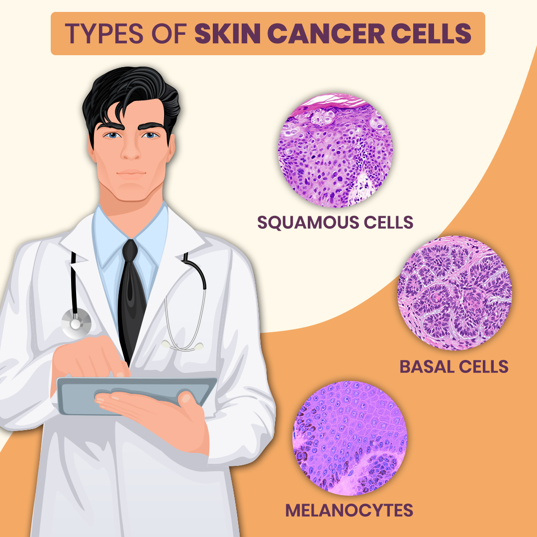 Understanding The Different Types Of Skin Cancer And Treatment Zeeva Clinic