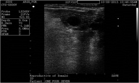 Transrectal sonogram of an anestrus buffalo. A CL with central echogenic lumen and small follicle are visible.