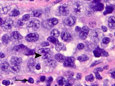 anaplastic-large-cell-lymphoma-[3-ln072-3].jpg