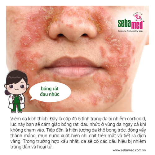 nhiễm corticoid