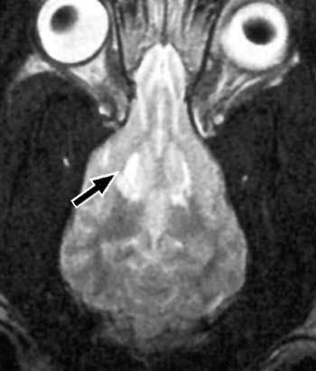 Dorsal planar, T2-weighted image of a dog with cerebral infarction
