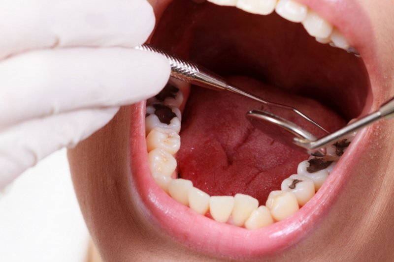 Không vệ sinh răng miệng đúng cách gây sâu răng