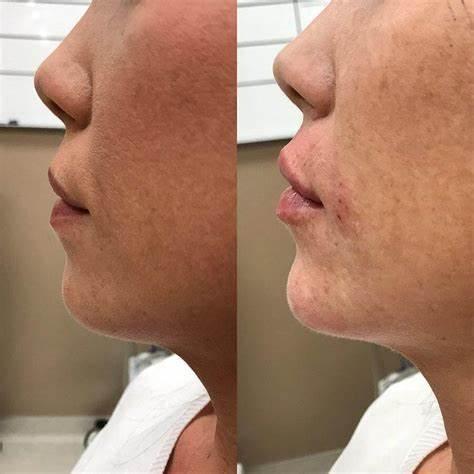 Double Chin Removal Treatment in birmingham