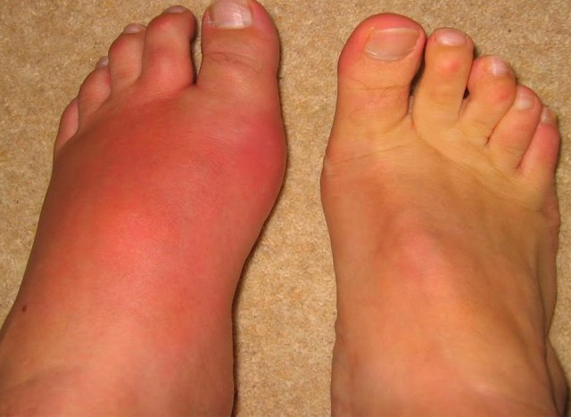 Набряк та почервоніння шкіри на ногах через алергію на холод