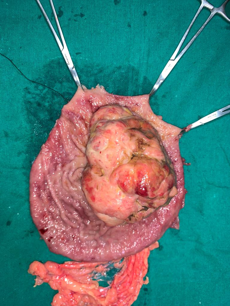 GIST found in stomach wall removed after surgery