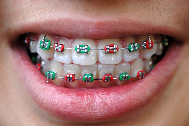 braces singapore cost