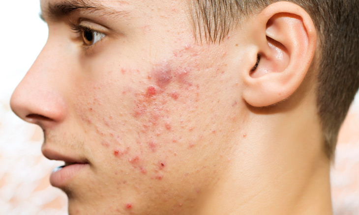 Da mụn và những mối nguy tiềm ẩn cho làn da với các tinh chất nhà Natural