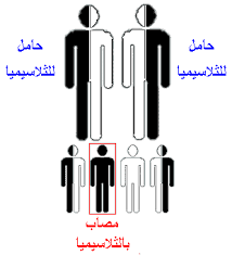 صورة توضيحية للإصابة بالثلاسيميا