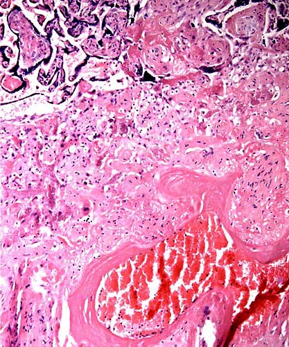 Decidua basalis with large maternal blood vessel showing fibrinoid replacement of its muscular wall. This is similar to minor changes of the decidual arteriopathy in cases of human pre-eclampsia