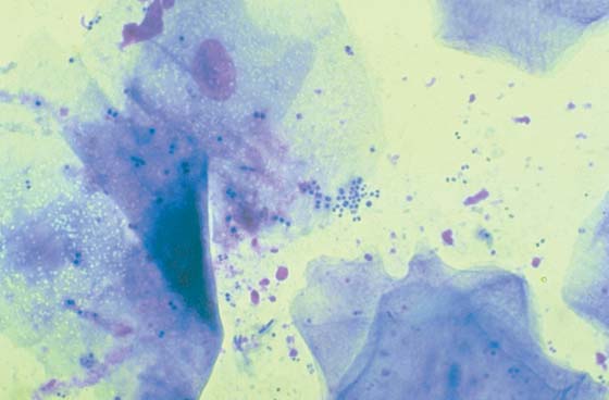 Cocci on an impression smear stained with DiffQuick (original magnification x1000)