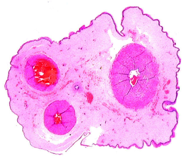 The other umbilical cord has a slightly larger allantoic duct in between the two arteries and small foci of squamous metaplasia on the surface.