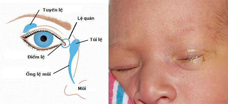 Triệu chứng tắc lệ đạo bẩm sinh