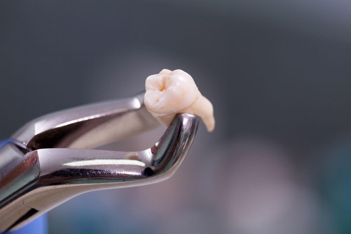 wisdom tooth extraction in Newmarket