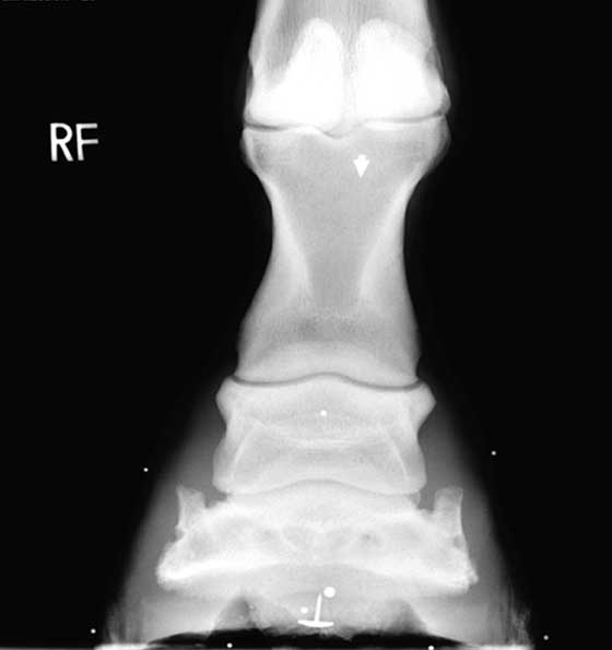 Horizontal DP radiograph of a foot with sheared heels. 