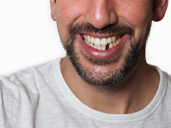 Things You Need to Know About Oral Implants
