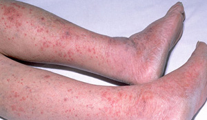 Non blanching rash on light skin
