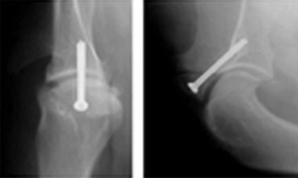 Postoperative radiographic views of a dog with avulsion of the biceps tendon origin at the supraglenoid tubercle
