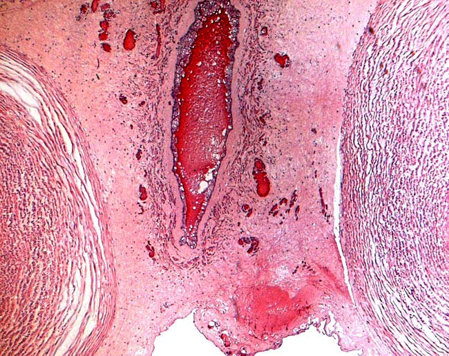 Central portion of umbilical cord near the placental surface