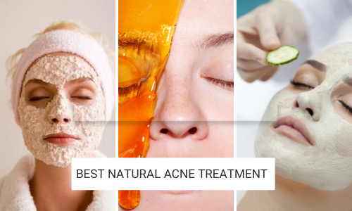 5 Easy Home Remedies for Acne 