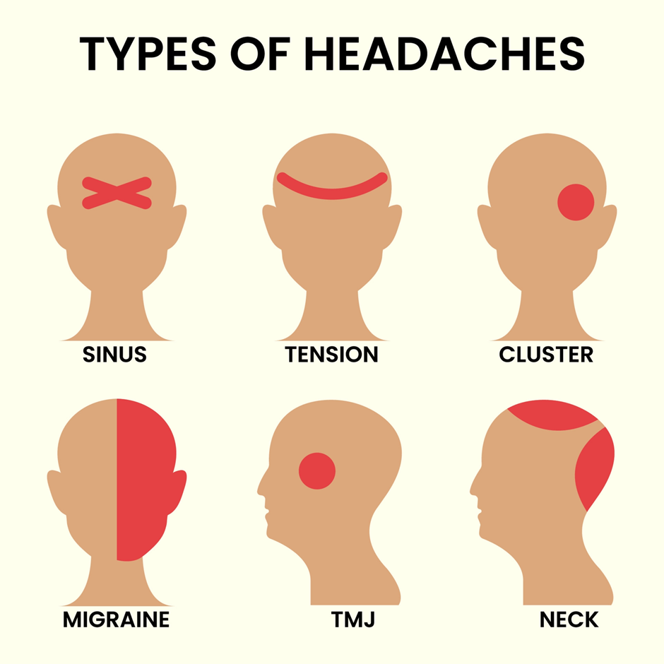 Types of Headaches
