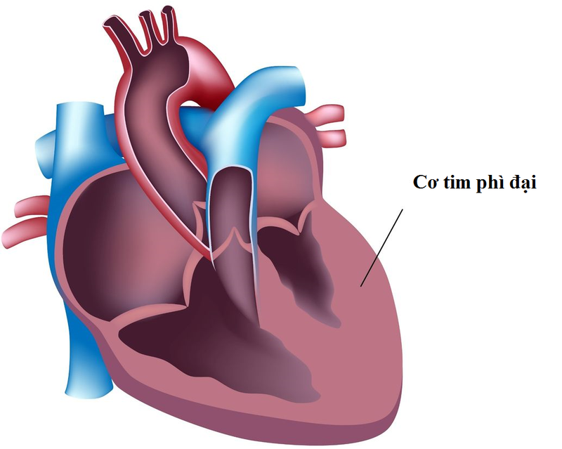 3 triệu chứng thường gặp và nguy cơ đột tử của bệnh cơ tim phì đại | Vinmec
