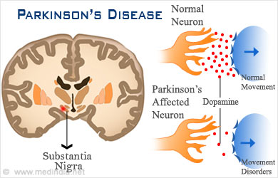 disease parkinson parkinsons causes brain symptoms stem treatment cell incidence patients dopamine diagnosis pd review cells research medindia patientinfo adjustments