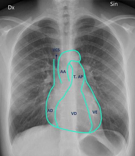Anatomia radiográfica do coração e dos vasos da base - imagem ilustrativa