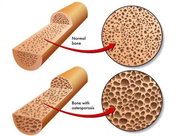 normal bone versus the effects of osteoporosis