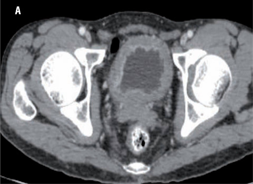 Tomografia computadorizada da pelve em fase portal mostrando espessamento difuso e irregular da bexiga e realce de suas paredes, sugestivo de neoplasia urotelial