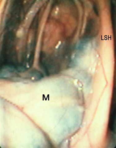 A large retropharyngeal melanoma (M) fills the floor of the medial compartment of the left guttural pouch in this horse. The left stylohyoid bone (LSH) is visible.