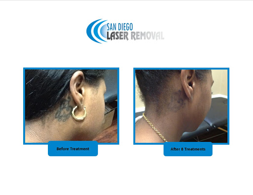 Explore hexagon tattoo ideas, creative tattoo ideas in San Diego, available at Removery Tattoo Removal & Fading