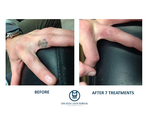 Explore autoimmune disease tattoo ideas, creative tattoo ideas in San Diego, available at Removery Tattoo Removal & Fading