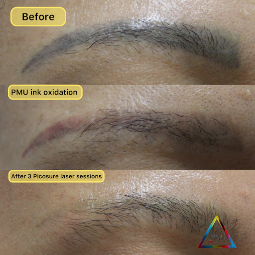 Explore miami tattoo ideas, creative tattoo ideas in New York, available at Ag2g Laser Tattoo Removal & MedSpa