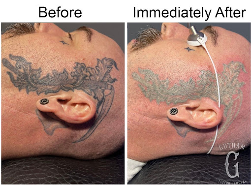 Explore tattoo ideas floral, creative tattoo ideas in Brooklyn, available at Gotham Tattoo Removal