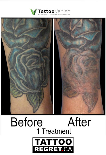 Tattoo Regret | Laser Tattoo Removal Richmond Hill