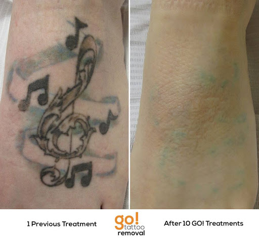 Explore skateboard tattoo ideas, creative tattoo ideas in Allentown, available at Removery Tattoo Removal & Fading