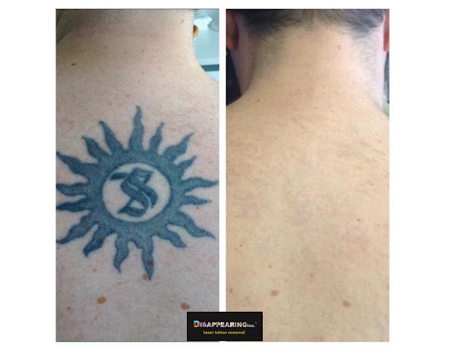 Explore rib tattoo ideas for men, creative tattoo ideas in Mineola, available at Removery Tattoo Removal & Fading