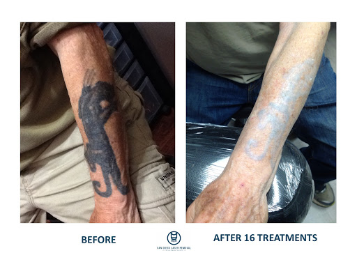 Explore gap filling tattoo ideas, creative tattoo ideas in San Diego, available at Removery Tattoo Removal & Fading