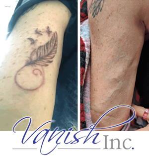 Explore amy winehouse tattoo ideas, creative tattoo ideas in Williamsport, available at Vanish Laser & Skin, Inc.