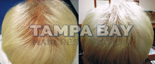 Hair Replacement Service «Tampa Bay Hair Restoration», reviews and photos, 1266 Turner St b, Clearwater, FL 33756, USA