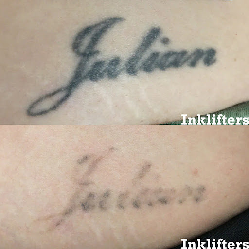 Explore spark plug tattoo ideas, creative tattoo ideas in Pleasant Grove, available at Inklifters Tattoo Removal