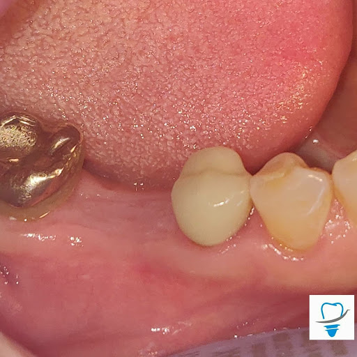 Dr. Eliezer Molina Pompa - Periodoncia e Implantes Dentales