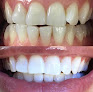 Naturally White Teeth Whitening