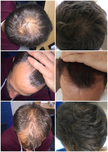 The Stockport Hair Loss Clinic - The Stockport Hair Loss Clinic