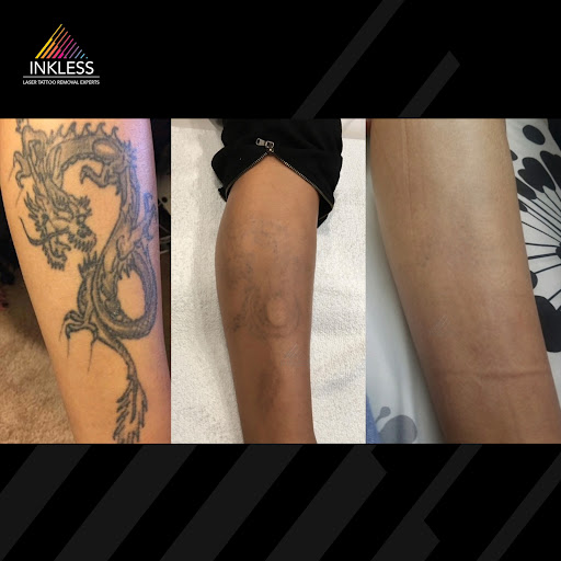 Explore waist tattoo ideas, creative tattoo ideas in Denver, available at Inkless Tattoo Removal