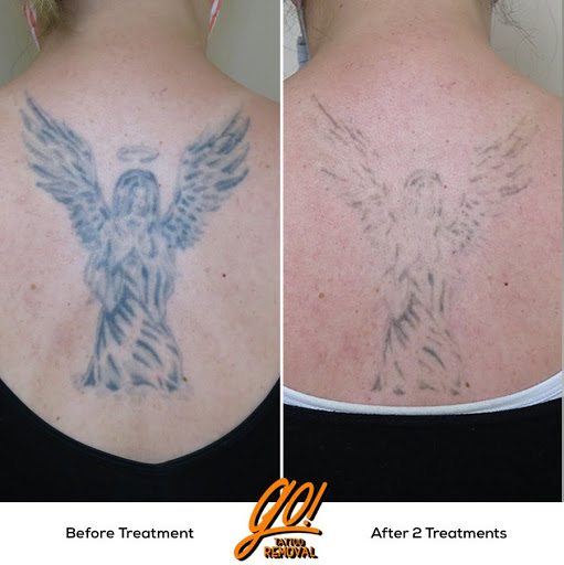 Find tattoo bracelet ideas for your next unique tattoo in Allentown at Removery Tattoo Removal & Fading