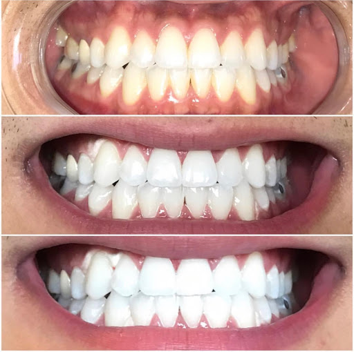 Carte Blanche Teeth Whitening - Mobile Cosmetic Teeth Whitening in Monterey Park CA
